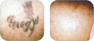 Tattoo Removal