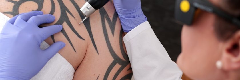 A person with tattoo getting a laser tattoo removal