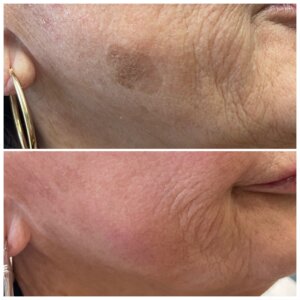 scar removal treatment