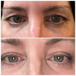 after and before image of eye treatment